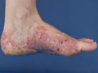 Pustulosis palmoplantaris