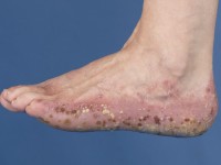 Pustulosis palmoplantaris