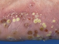 Pustulosis palmoplantaris