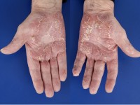 Pustulosis palmoplantaris