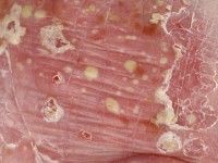Pustulosis palmoplantaris
