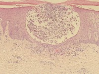 Pustulosis palmoplantaris