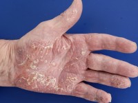 pustulosis palmoplantaris