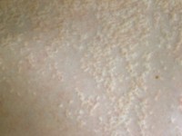 Pseudoxanthoma elasticum