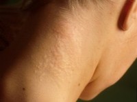 Pseudoxanthoma elasticum