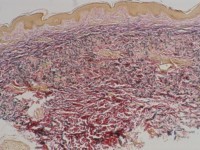 Pseudoxanthoma elasticum