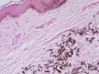 Pseudoxanthoma elasticum