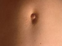 Pseudoxanthoma elasticum