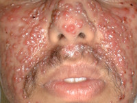 Pyoderma faciale (rosacea fulminans)