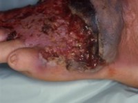 Pyoderma gangrenosum