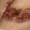 Pyoderma gangrenosum