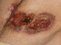 Pyoderma gangrenosum