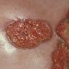 Pyoderma gangrenosum