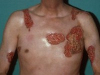 Pyoderma gangrenosum bij de ziekte van Crohn