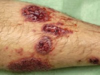 Pyoderma gangrenosum
