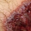 Pyoderma gangrenosum