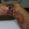 Pyoderma gangrenosum