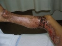 Te laat herkende pyoderma gangrenosum