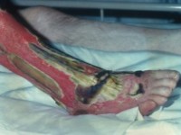 Te laat herkende pyoderma gangrenosum