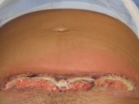 Pyoderma gangrenosum na keizersnede, bij verdenking op anti-fosfolipiden syndroom