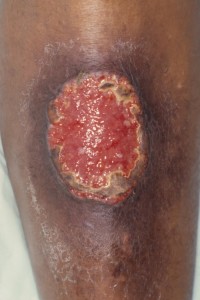 Pyoderma gangrenosum e.c.i.