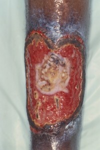 Pyoderma gangrenosum e.c.i.
