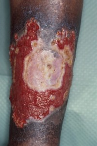 Pyoderma gangrenosum e.c.i.