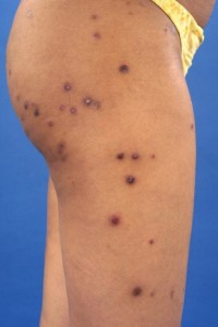 Pyoderma gangrenosum bij auto-immuun hepatitis en later ook de ziekte van Crohn