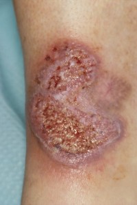 Pyoderma gangrenosum e.c.i.