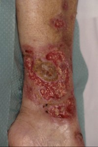 Pyoderma gangrenosum e.c.i.