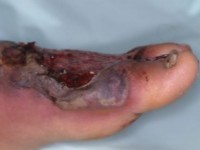 Pyoderma gangrenosum