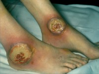 Pyoderma gangrenosum bij SLE