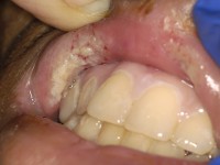 Pyoderma gangrenosum