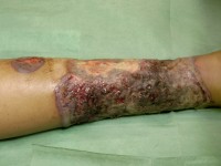 Pyoderma gangrenosum
