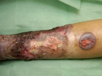 Pyoderma gangrenosum