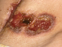 Pyoderma gangrenosum rond stoma bij de ziekte van Crohn