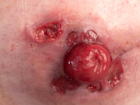 Pyoderma gangrenosum rond stoma bij de ziekte van Crohn
