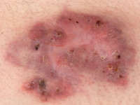 Pyoderma vegetans