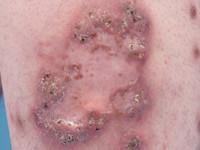 Pyoderma vegetans