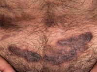 Pyoderma vegetans bij Crohn