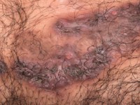 Pyoderma vegetans bij Crohn