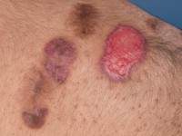 Pyoderma vegetans bij Crohn
