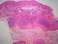 Plaque form hidradenitis suppurativa