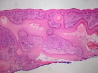 Plaque form hidradenitis suppurativa