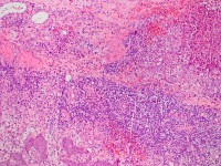 Plaque form hidradenitis suppurativa