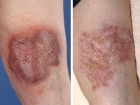 Plaque form hidradenitis suppurativa