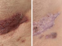 Plaque form hidradenitis suppurativa