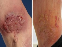 Plaque form hidradenitis suppurativa