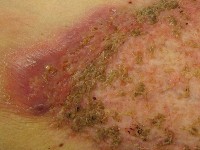 Plaque form hidradenitis suppurativa