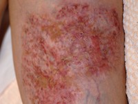 Plaque form hidradenitis suppurativa